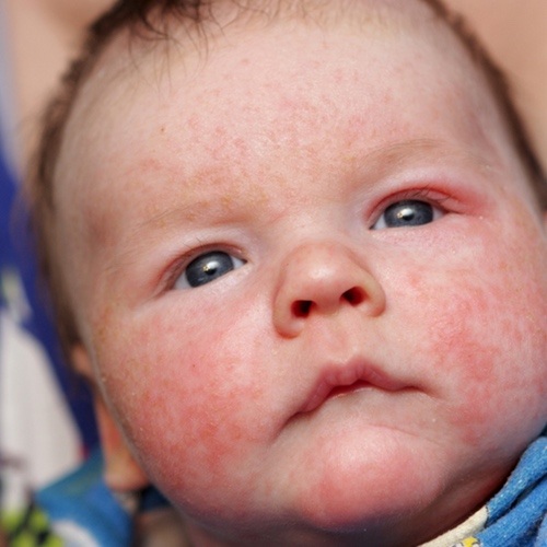 6 Najczestszych Przyczyn Wysypki U Niemowlat Objawy I Leczenie Babyboom